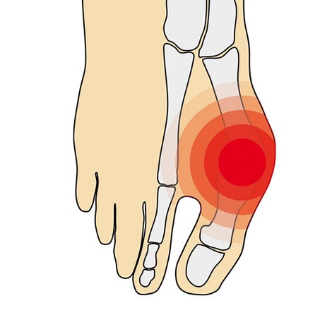 ARTHROVEN  Hallux valgus sneakersok 3
